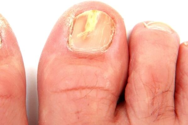 deteriorarea plăcii unghiei din cauza unei infecții fungice