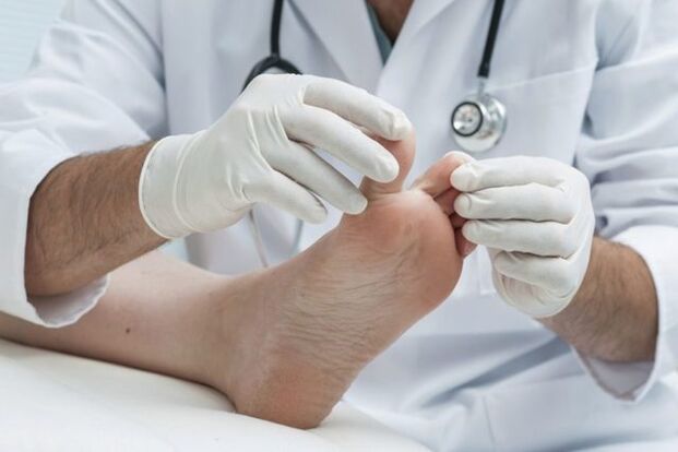 diagnosticul ciupercii piciorului de către un medic